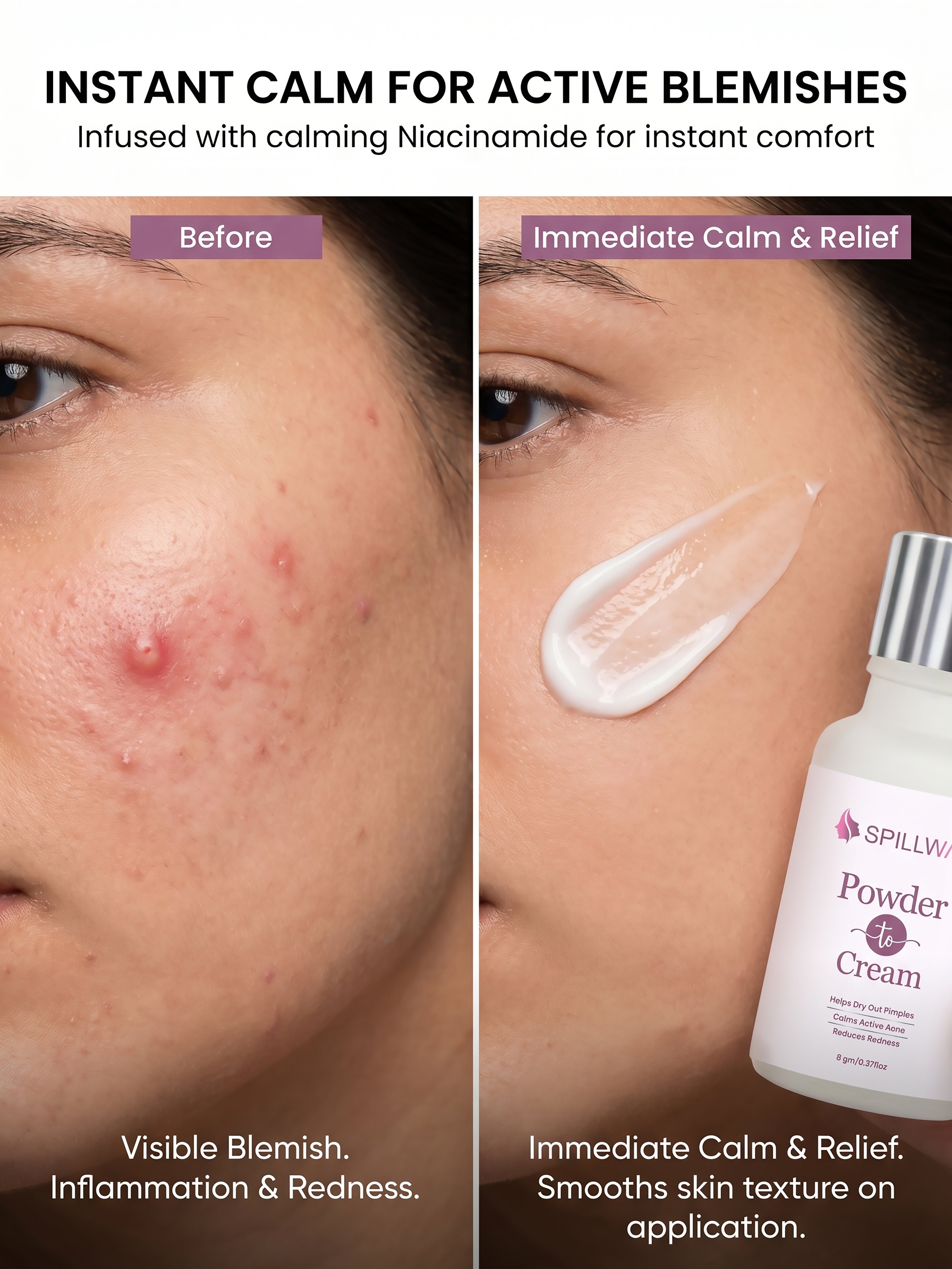 Spillway Acne Control Powder to Cream Treatment