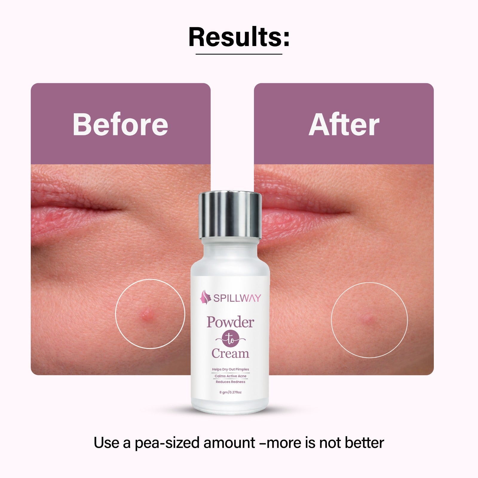Spillway Acne Control Powder to Cream Treatment